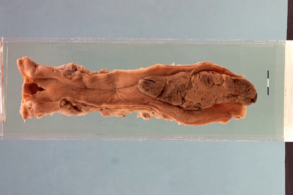 Sarcoma of the oesophagus