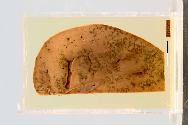 Eclamptic necrosis of the liver