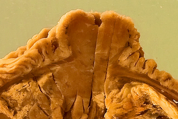 Endocrine cell tumour (Carcinoid) of the Ampulla of Vater