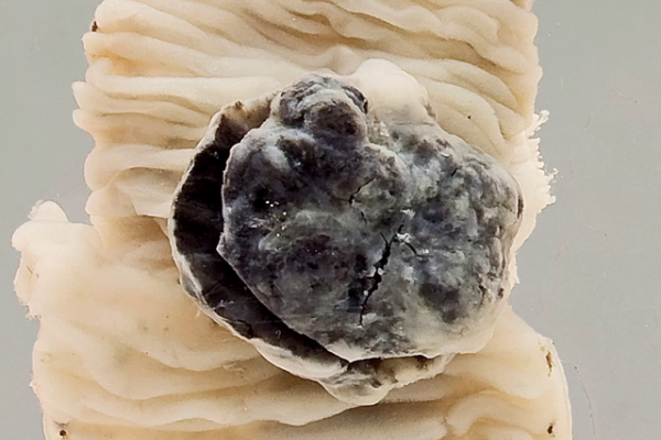 Leiomyosarcoma of the jejunum (GIST)
