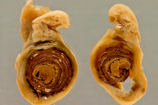 Appendicitis (faecolith)