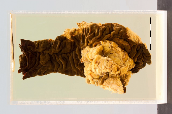 Caecal adenocarcinoma