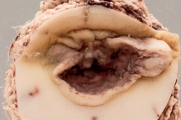 Squamous carcinoma of the anus