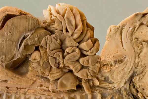 Sacro-coccygeal Teratoma
