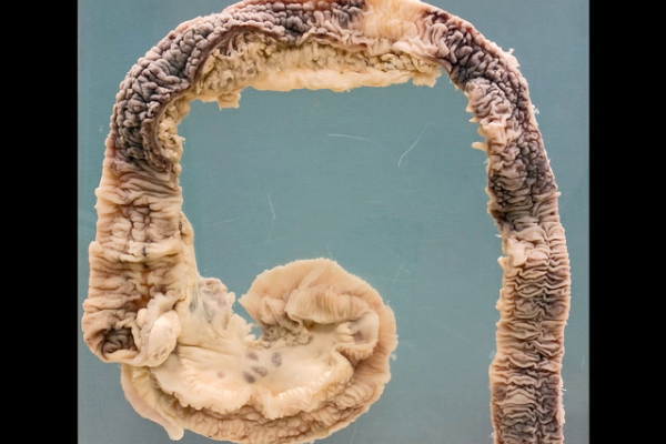 Crohn's disease