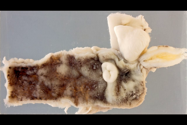 Ulcerative colitis