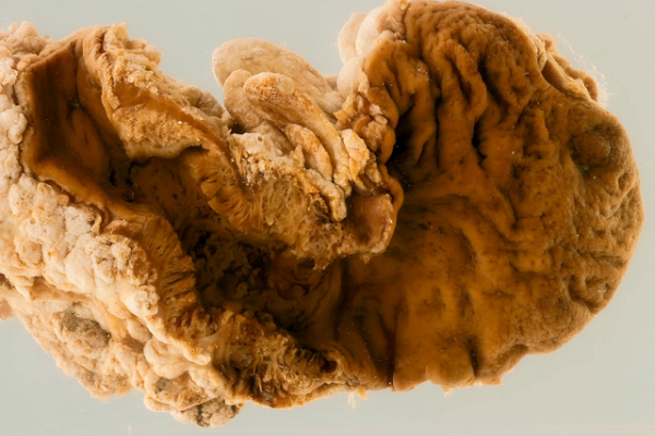 Adenocarcinoma developing in ulcerative colitis