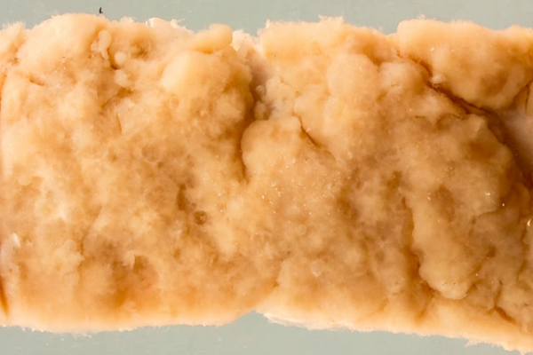 Coelomic spread of carcinoma of the colon