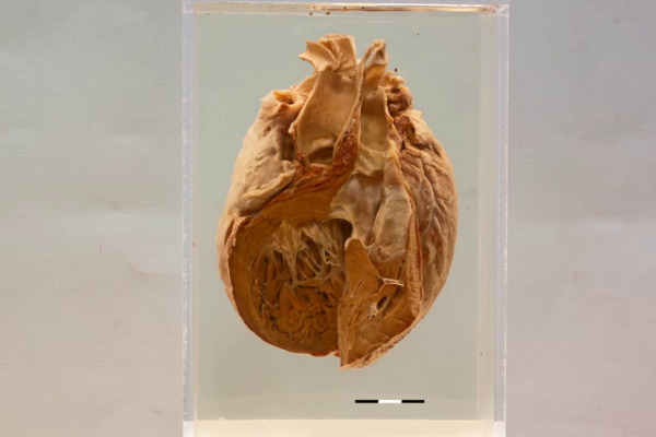 Heart Uni-ventricle