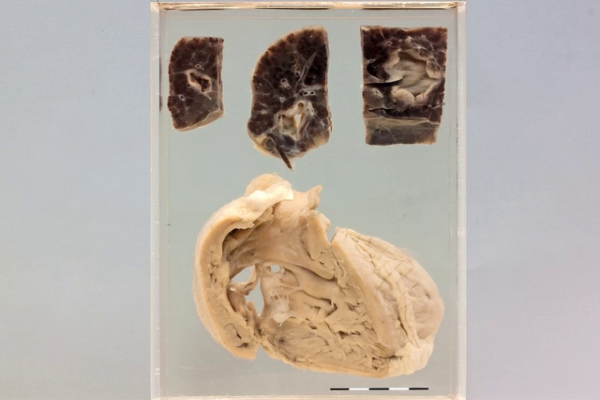 Multiple mycotic aneurysms due to bacterial endocarditis