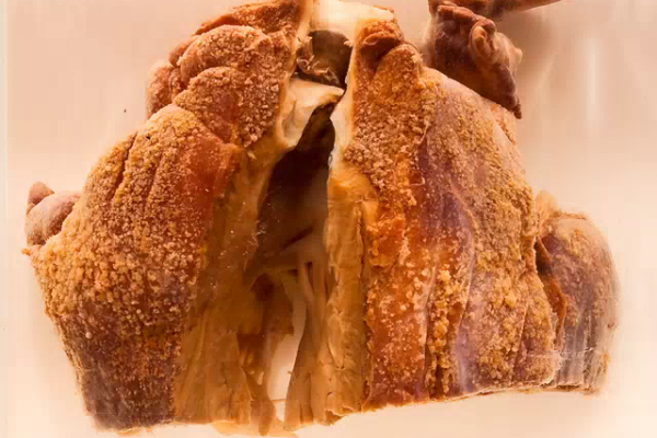 Congenital pulmonary stenosis with straddling embolus