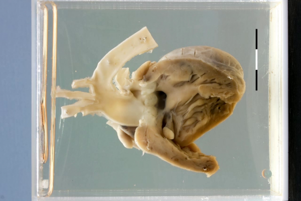 Truncus arteriosus with VSD