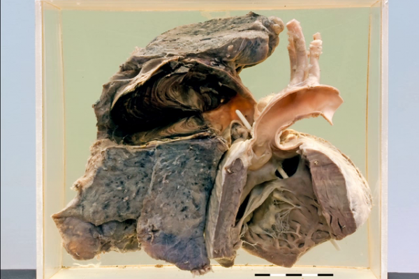 Transposition with a massive pulmonary artery aneurysm