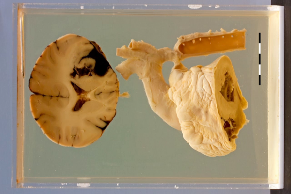 Coarctation with intra-cerebral haemorrhage