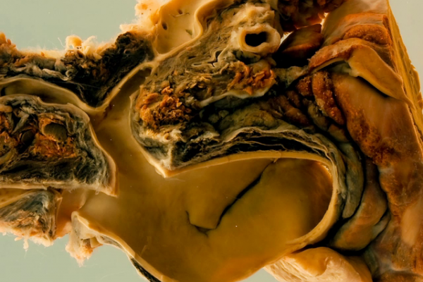 Coarctation with aortic dissection and rupture