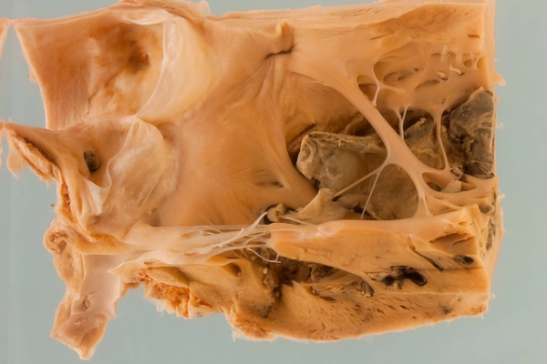 Sequelae of myocardial infarction