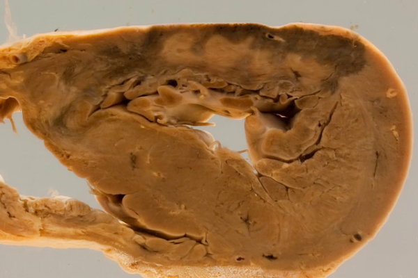 Acute myocardial infarction