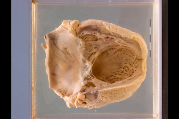 Acute myocardial infarction