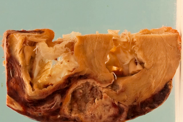 Sequelae of myocardial infarction