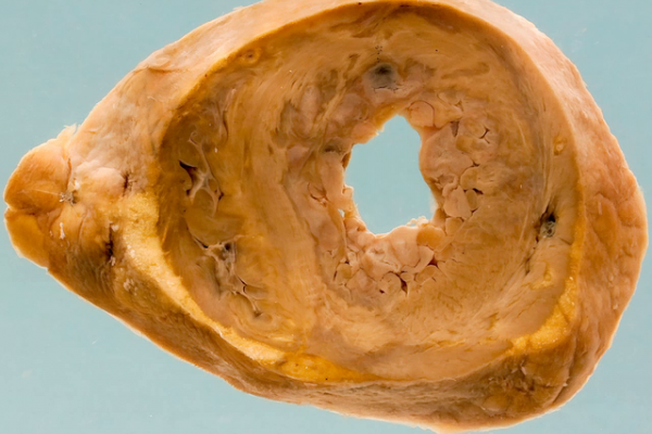 Myocardial infarct