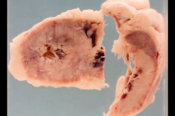 Acute myocardial infarction