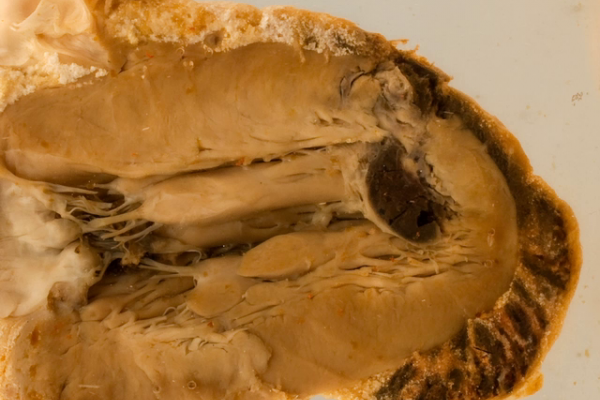 Cardiac rupture following myocardial infarction