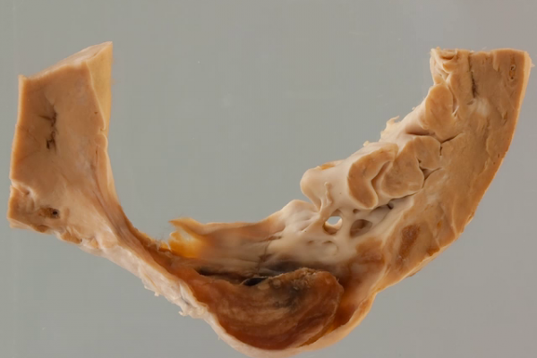 Left ventricular aneurysm