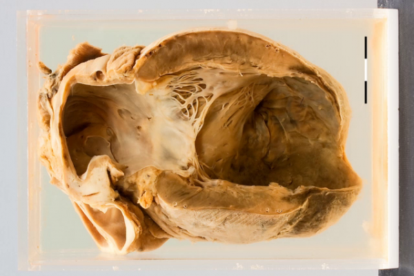 Left ventricular aneurysm