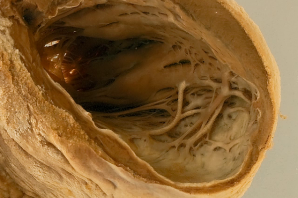 Myocardial fibrosis following infarction