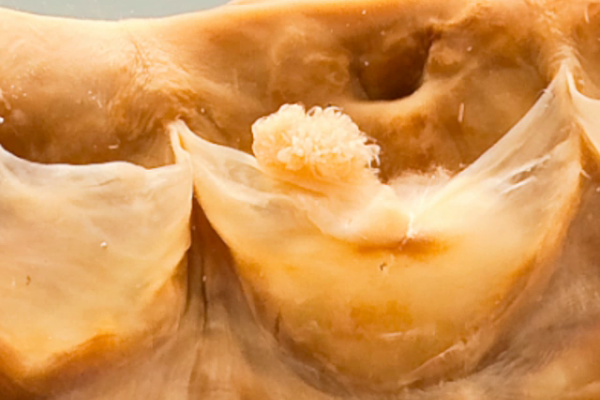 Polypoid lesions of the cardiac valves