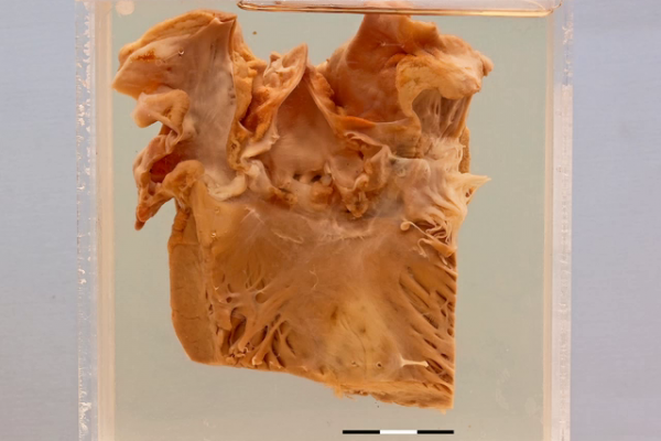 Acute bacterial endocarditis