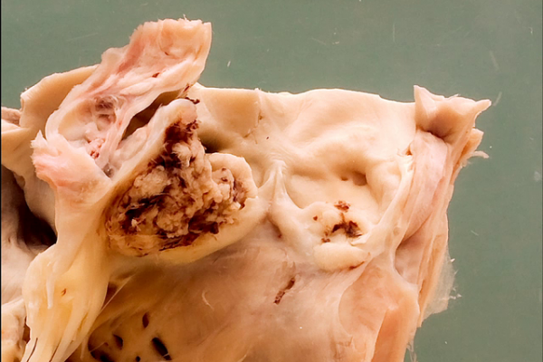 Candida albicans endocarditis