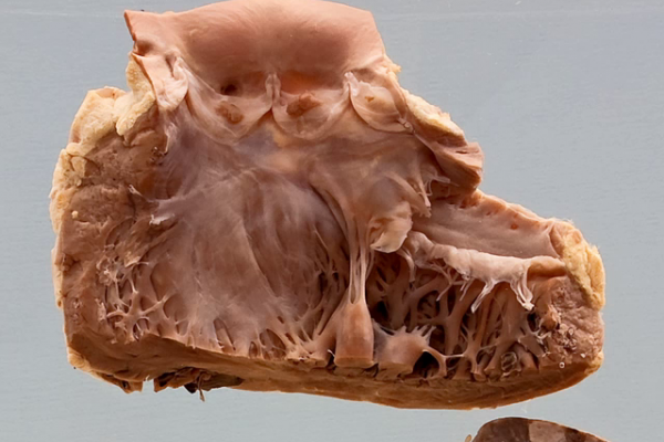Nonbacterial thrombotic endocarditis (Marantic)