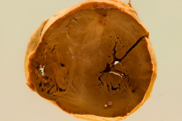 Cardiac manifestations of Von Gierke's disease