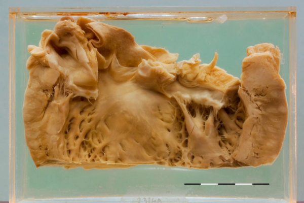 Sarcoidosis of the myocardium