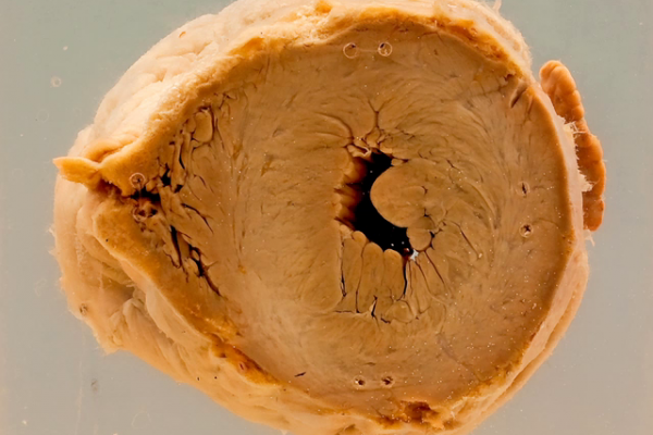 Concentric hypertrophy of the left ventricle