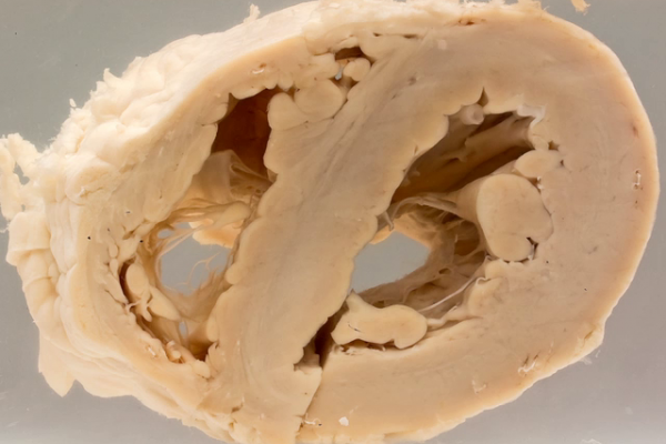 Ischaemic cardiac hypertrophy