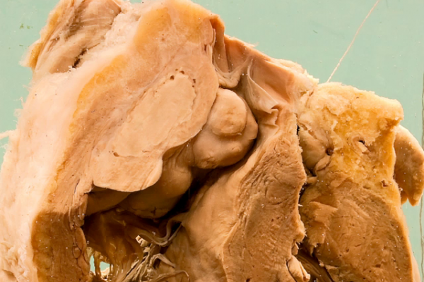 Syphilitic gumma of the right ventricle
