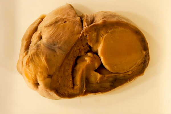 Congenital rhabdomyoma