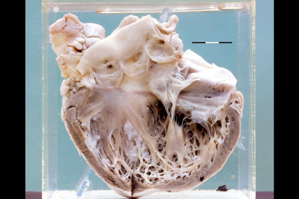 Heart in carcinoid syndrome