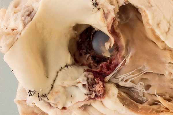 Thrombus on a Starr-Edwards valve