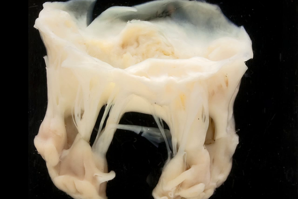 Mitral stenosis