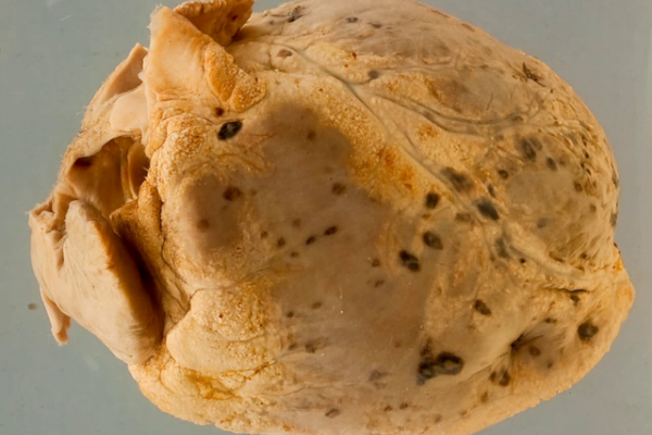 Pericardial leukaemic deposits