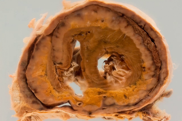 Malignant pericarditis