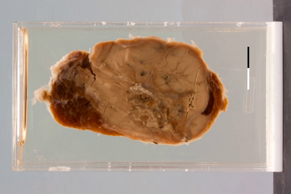 Papillary carcinoma