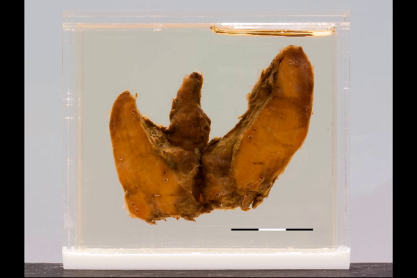 Follicular carcinoma