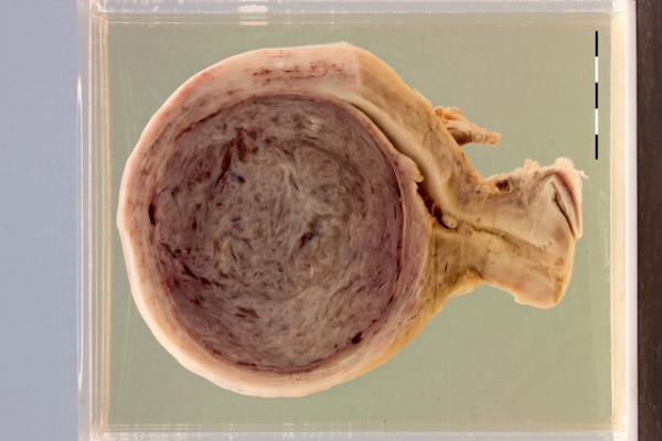 Leiomyoma variants (x3)