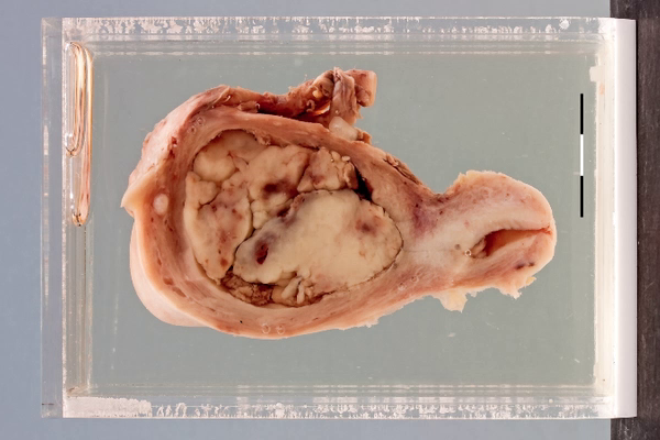 Carcinomasarcoma (MMMT) of the uterus