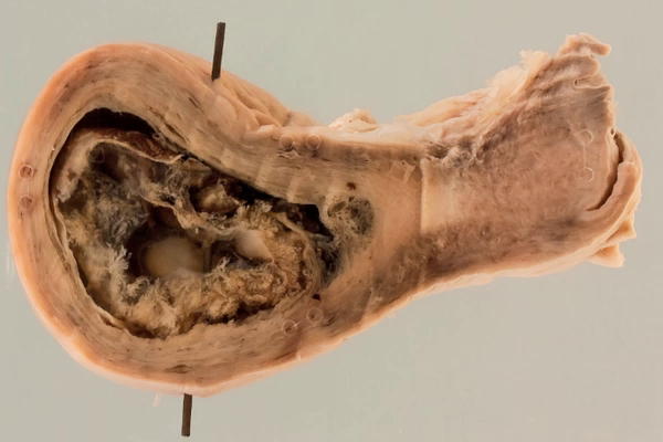 Air embolism following laparoscopy