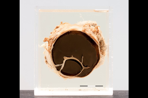 Endometriosis of the ovary